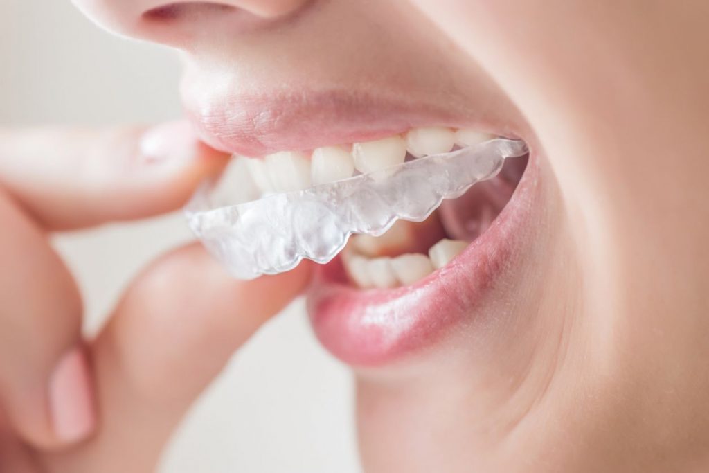 clear Invisalign braces